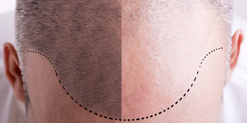 Hair Transplant Turkey