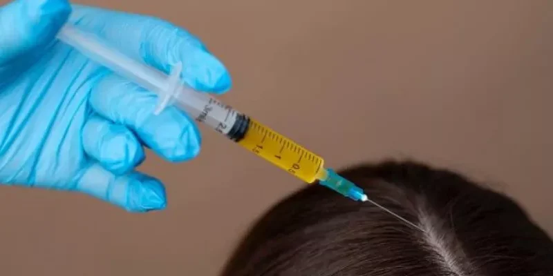 Mésothérapie Capillaire