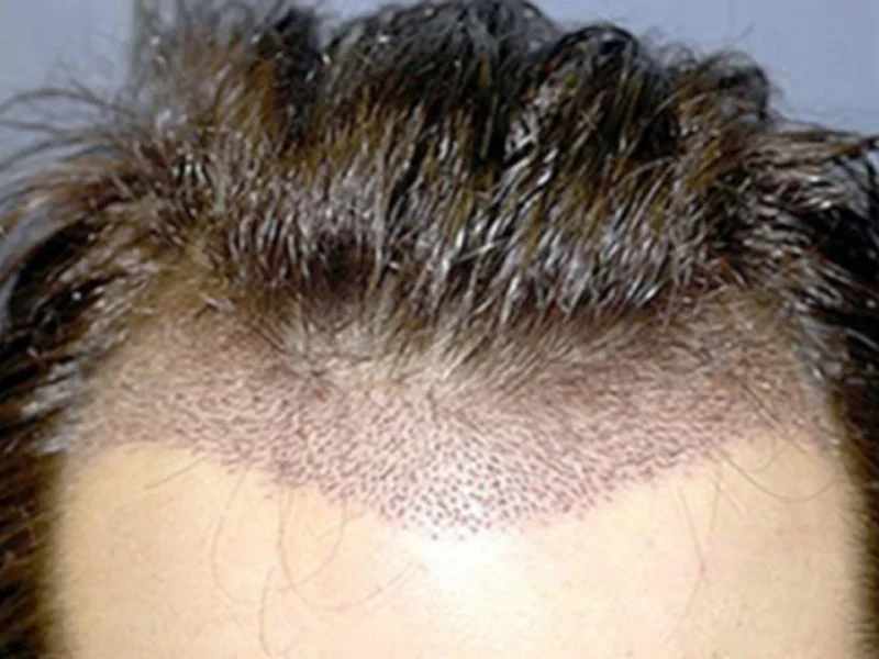 Greffe de cheveux DHI