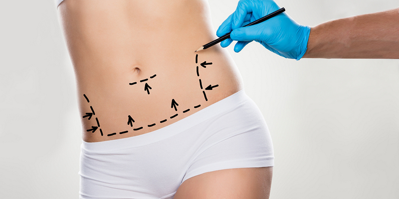 Liposuction